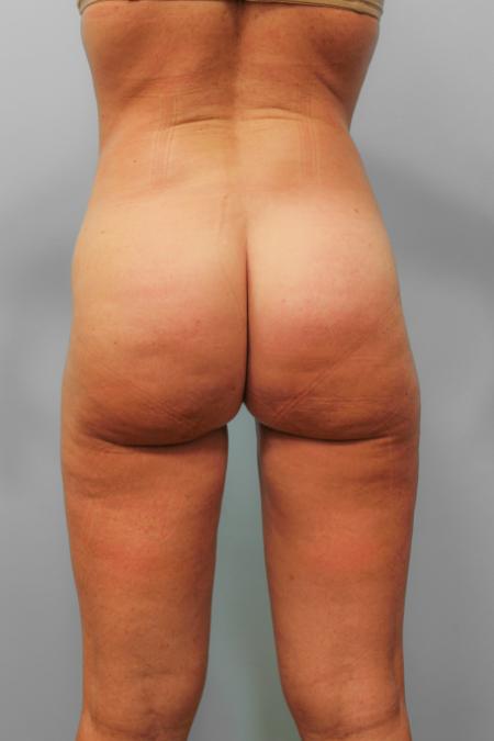 After image 3 Case #109171 - Smart Lipo