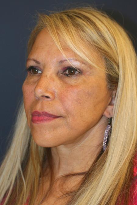 After image 2 Case #109266 - Facelift/Necklift