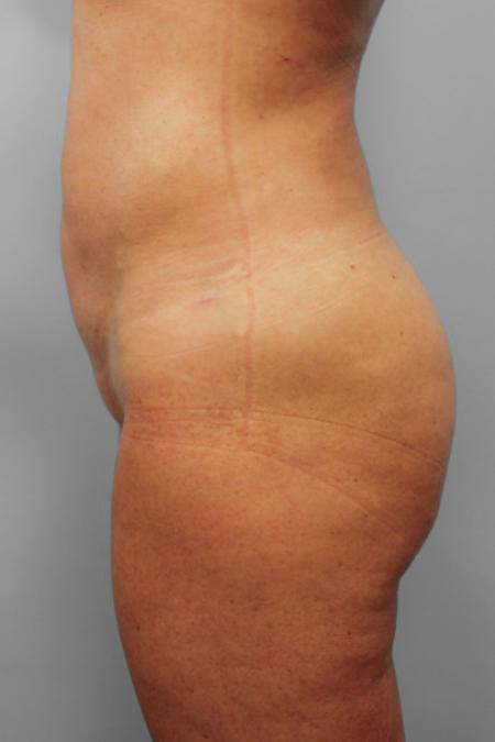 After image 2 Case #109171 - Smart Lipo