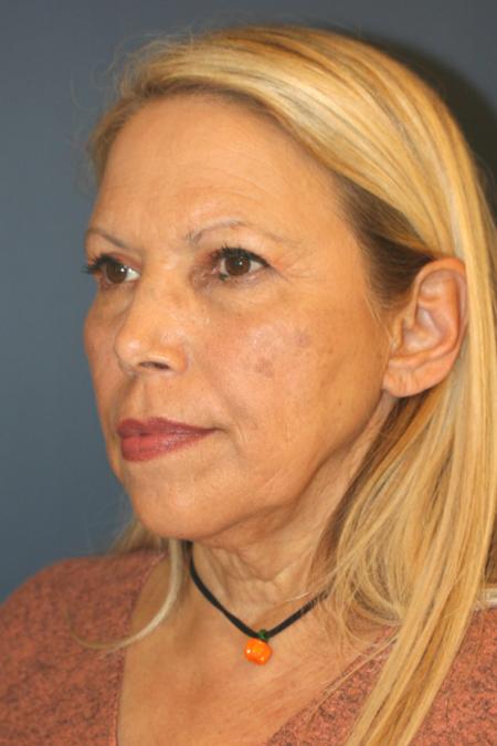 Before image 2 Case #109266 - Facelift/Necklift