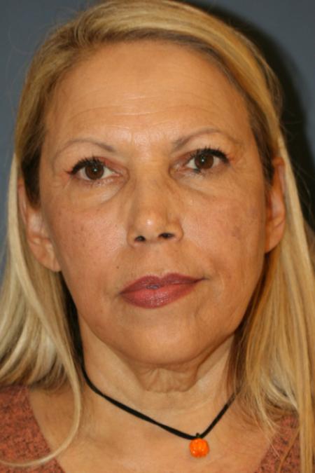 Before image 1 Case #109266 - Facelift/Necklift
