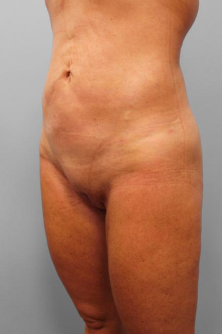 After image 1 Case #109171 - Smart Lipo