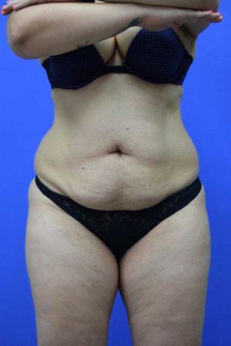 Before image 1 Case #109506 - Drainless Tummy Tuck