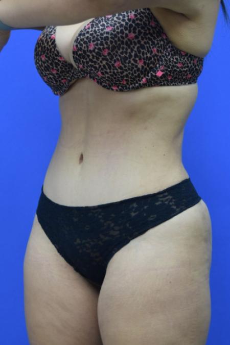 After image 2 Case #109506 - Drainless Tummy Tuck