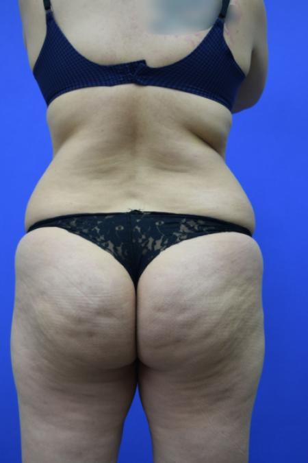 Before image 5 Case #109506 - Drainless Tummy Tuck
