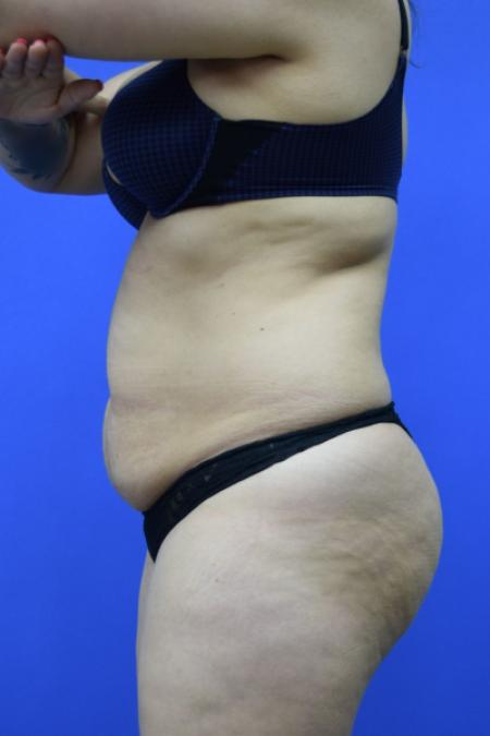 Before image 3 Case #109506 - Drainless Tummy Tuck