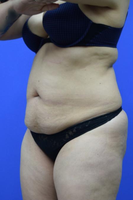 Before image 2 Case #109506 - Drainless Tummy Tuck