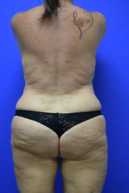 After image 5 Case #109496 - Mommy makeover