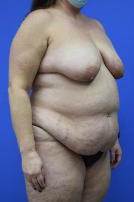Before image 2 Case #109496 - Mommy makeover