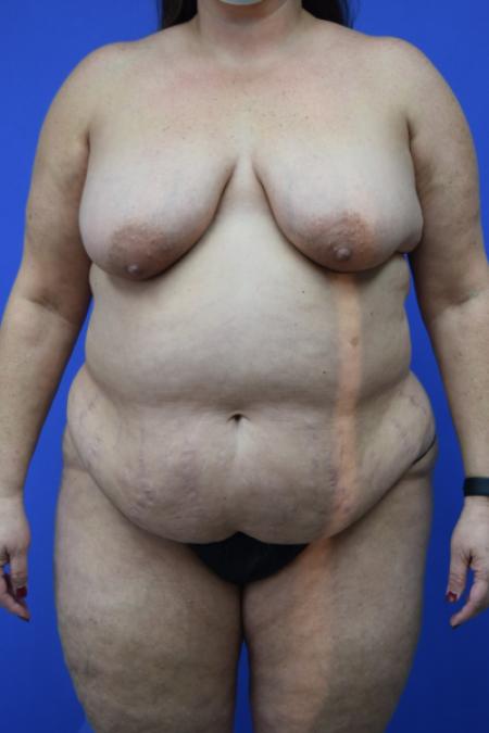 Before image 1 Case #109496 - Mommy makeover