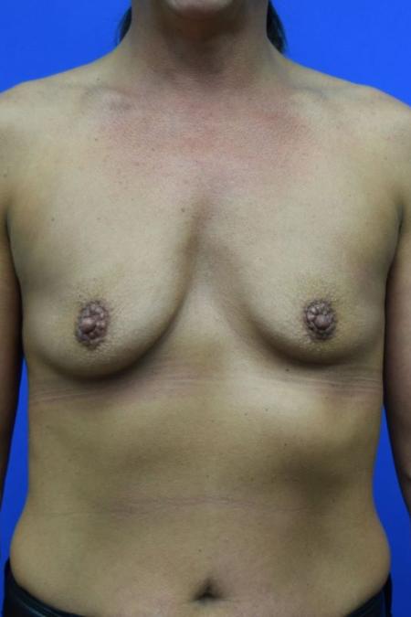 Before image 1 Case #109501 - Breast augmentation with silicone gel implants 