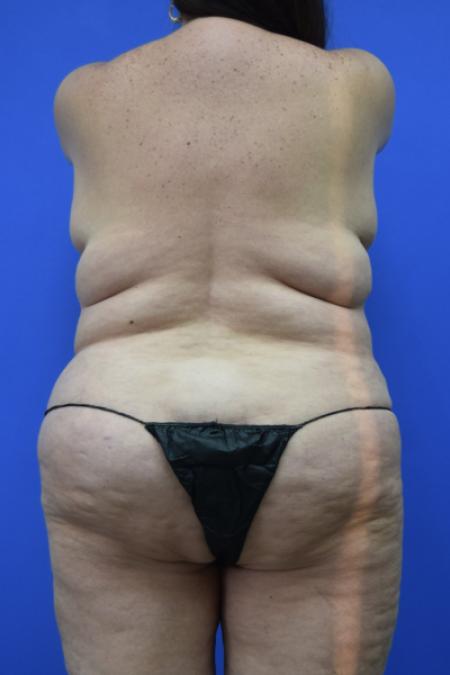 Before image 5 Case #109496 - Mommy makeover