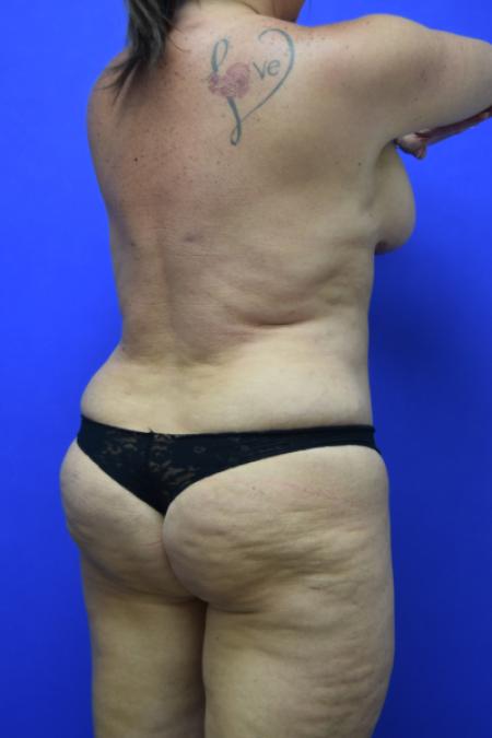After image 4 Case #109496 - Mommy makeover