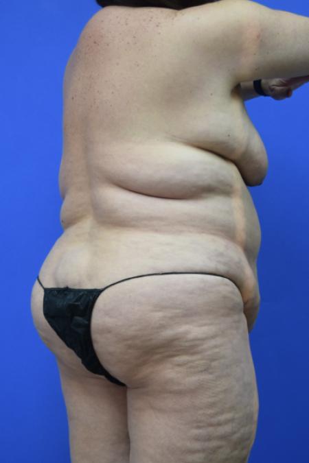 Before image 4 Case #109496 - Mommy makeover