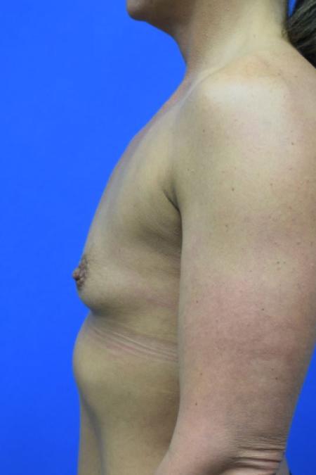 Before image 3 Case #109501 - Breast augmentation with silicone gel implants 