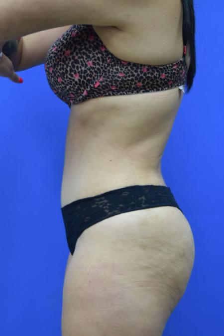 After image 3 Case #109506 - Drainless Tummy Tuck