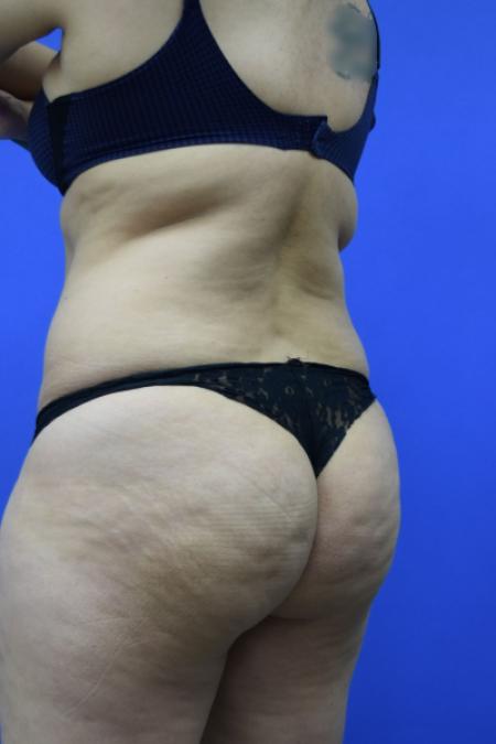 Before image 4 Case #109506 - Drainless Tummy Tuck