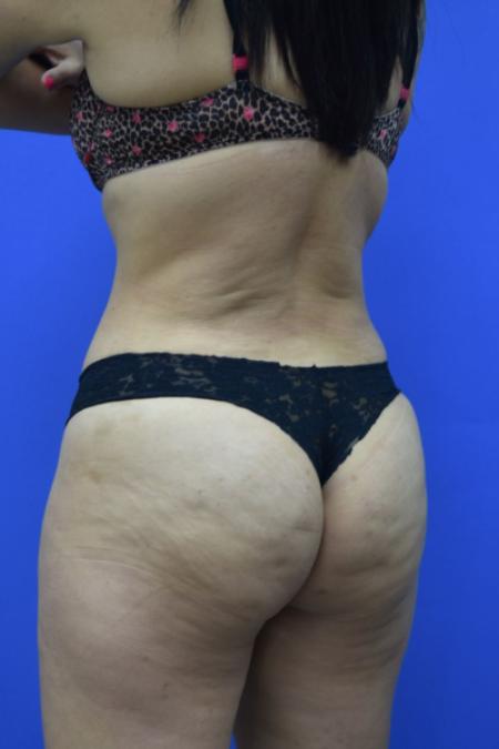 After image 4 Case #109506 - Drainless Tummy Tuck