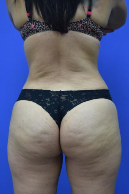 After image 5 Case #109506 - Drainless Tummy Tuck