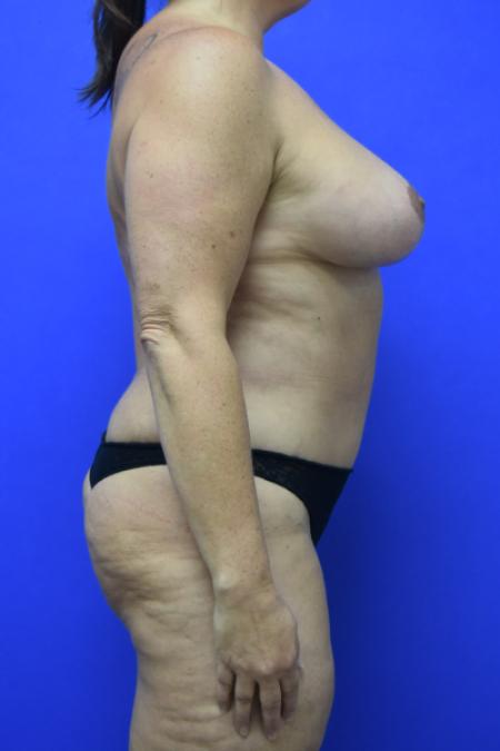 After image 3 Case #109496 - Mommy makeover