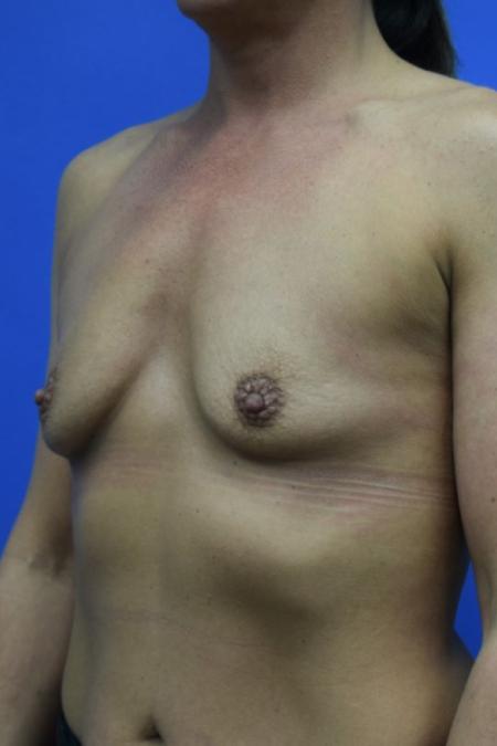 Before image 2 Case #109501 - Breast augmentation with silicone gel implants 