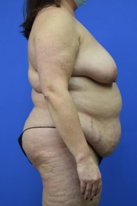 Before image 3 Case #109496 - Mommy makeover