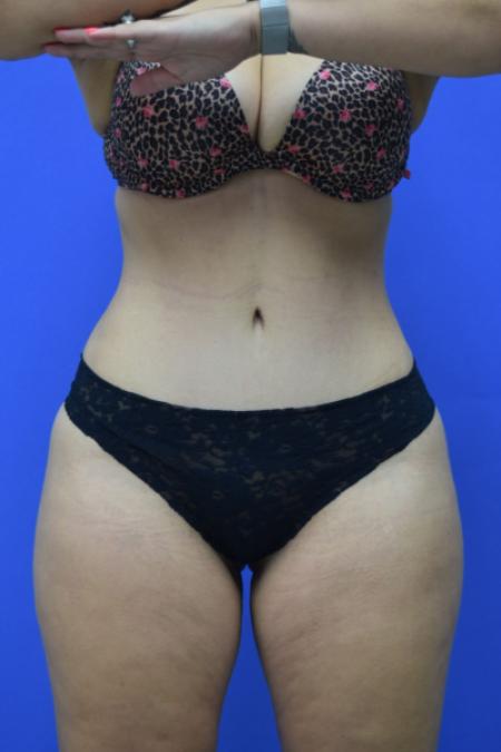 After image 1 Case #109506 - Drainless Tummy Tuck