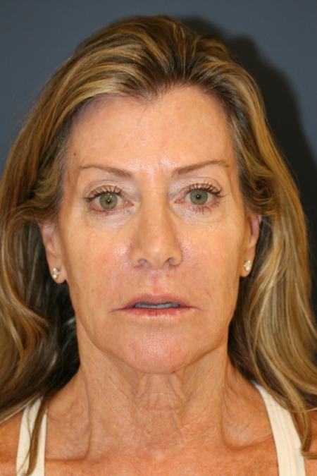 Before image 1 Case #109666 - Female Facial Rejuvenation