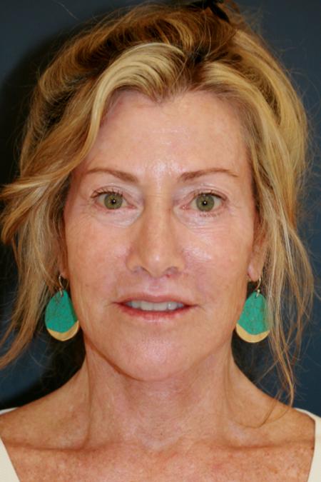 After image 1 Case #109666 - Female Facial Rejuvenation