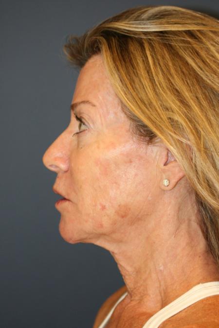 Before image 3 Case #109666 - Female Facial Rejuvenation