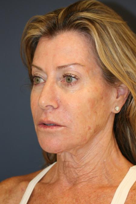 Before image 2 Case #109666 - Female Facial Rejuvenation