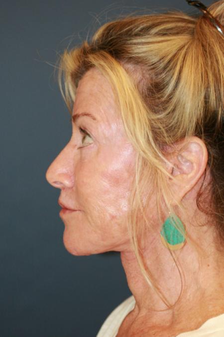 After image 3 Case #109666 - Female Facial Rejuvenation