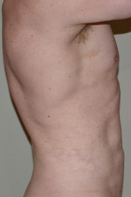 After image 3 Case #109981 - VASER Hi Def Lipo