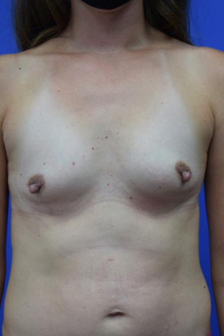 Before image 1 Case #109781 - Silicone Breast Augmentation