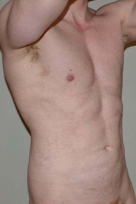 After image 4 Case #109981 - VASER Hi Def Lipo