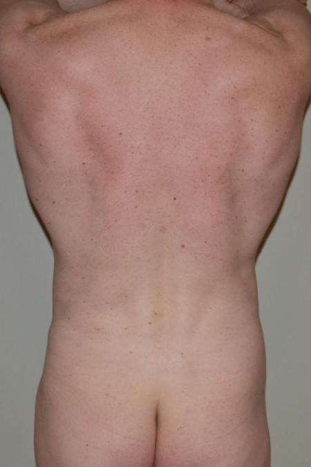 After image 5 Case #109981 - VASER Hi Def Lipo