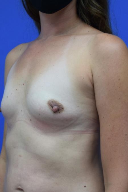 Before image 2 Case #109781 - Silicone Breast Augmentation