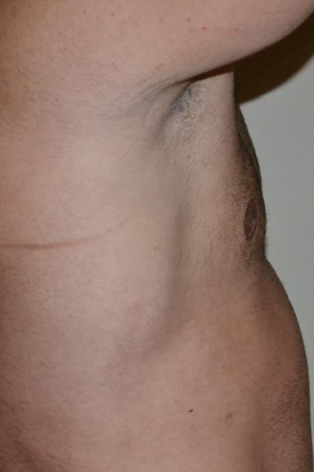After image 4 Case #109991 - Gynecomastia and VASER liposuction of chest