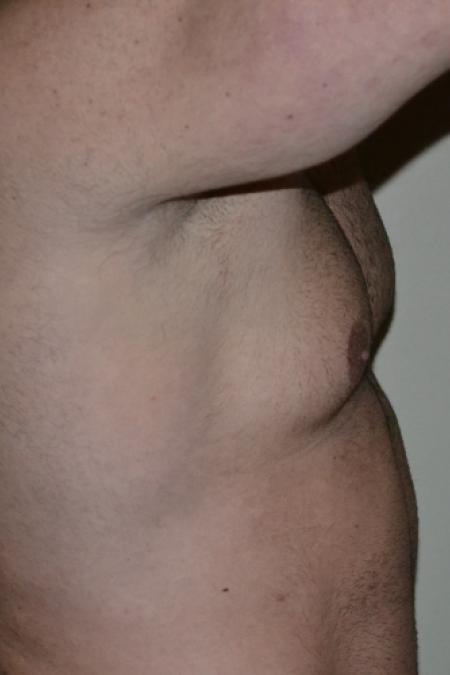 Before image 4 Case #109991 - Gynecomastia and VASER liposuction of chest