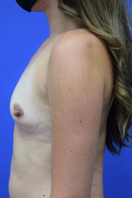 Before image 3 Case #109781 - Silicone Breast Augmentation