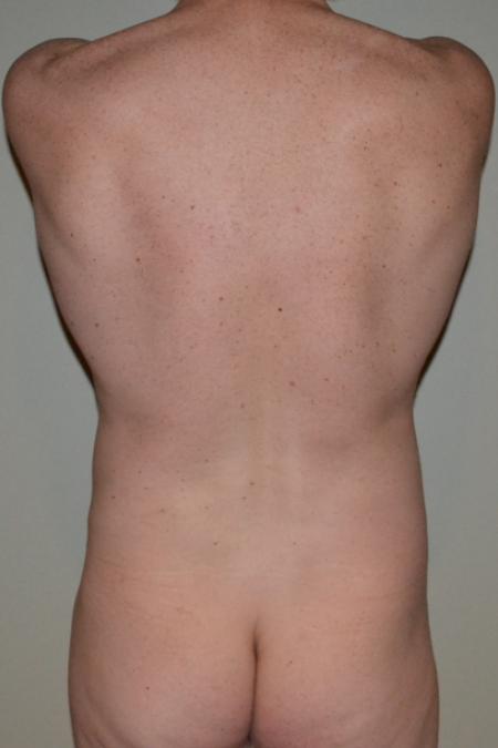 Before image 5 Case #109981 - VASER Hi Def Lipo