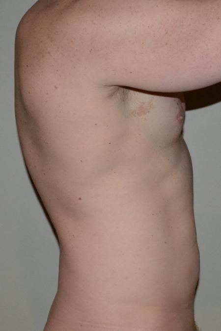 Before image 3 Case #109981 - VASER Hi Def Lipo