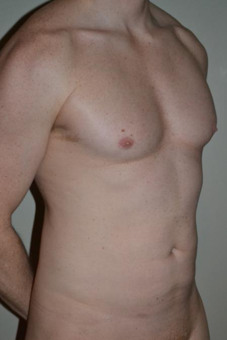 Before image 2 Case #109981 - VASER Hi Def Lipo