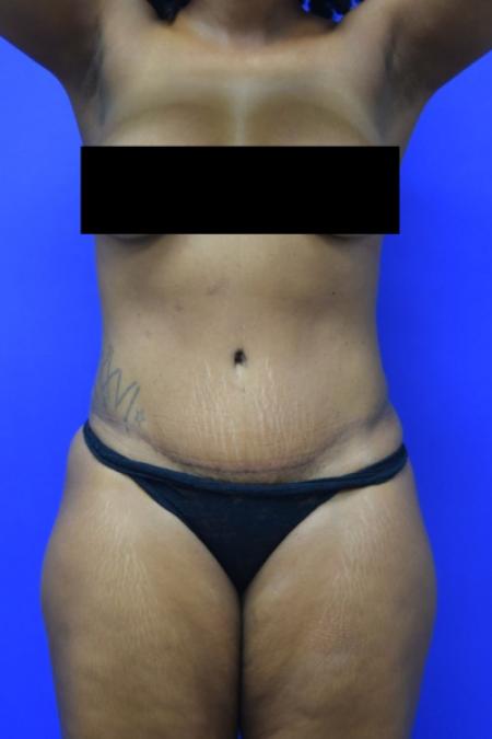 After image 1 Case #110106 - Drainless tummy tuck with liposuction