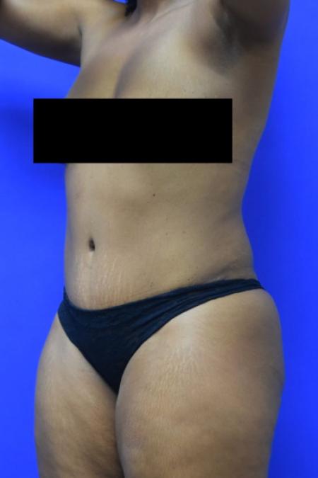 After image 2 Case #110106 - Drainless tummy tuck with liposuction