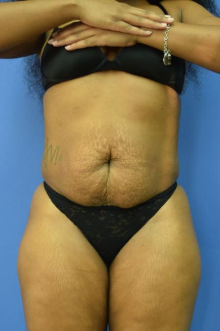 Before image 1 Case #110106 - Drainless tummy tuck with liposuction