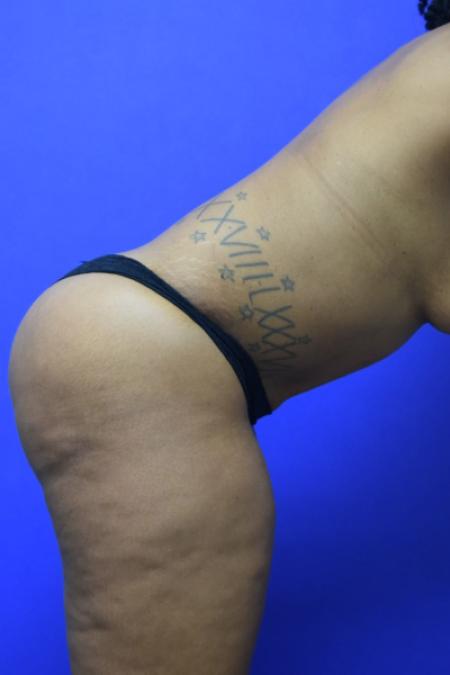 After image 3 Case #110106 - Drainless tummy tuck with liposuction