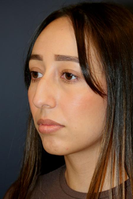 Before image 2 Case #110166 - Female Rhinoplasty