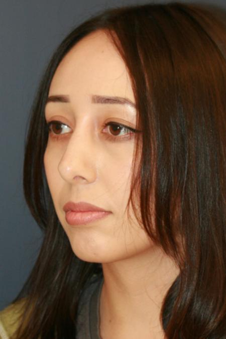 After image 2 Case #110166 - Female Rhinoplasty