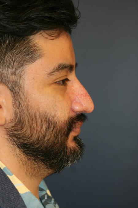 Before image 2 Case #110236 - Male Open Rhinoplasty